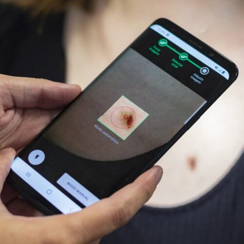 mole-check Skin check